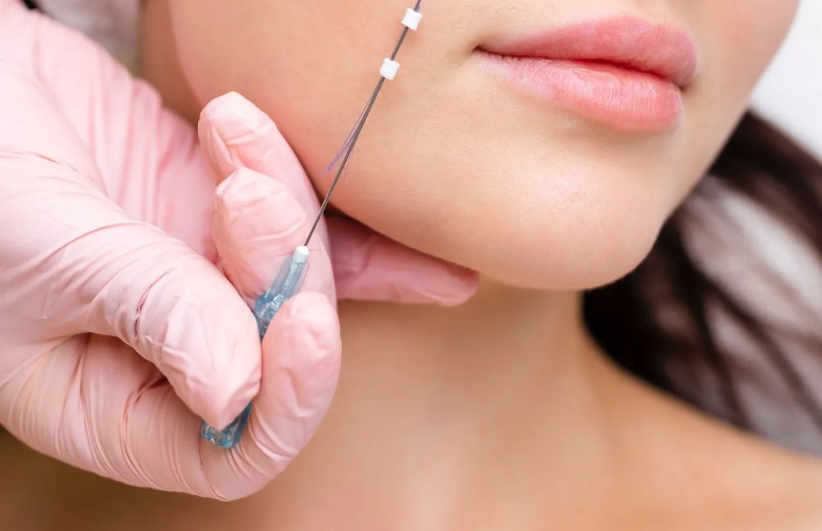 値段が高くダウンタイムもありますが、これが一番引き上がる ! 切らずにシワ・たるみの改善を◎