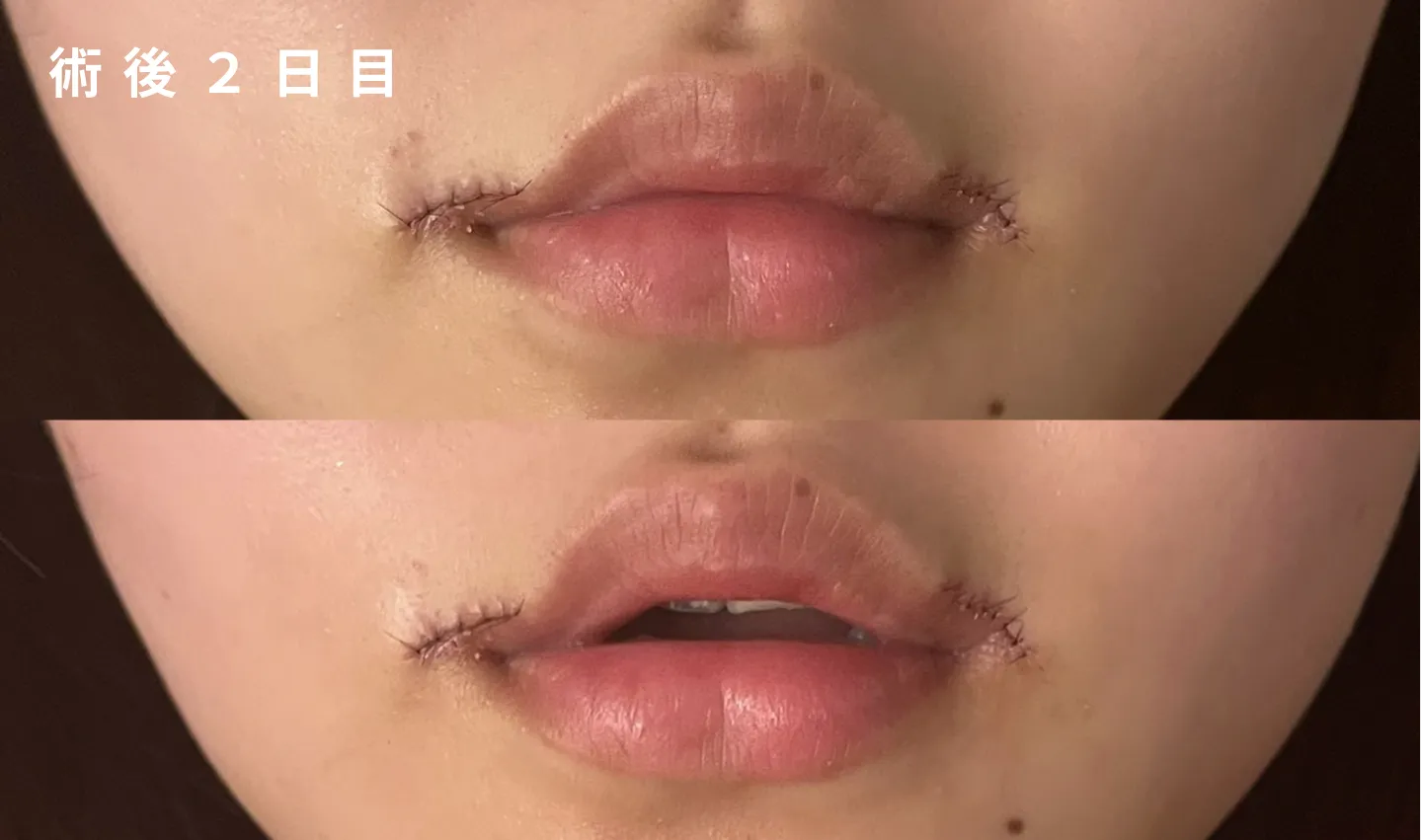 施術直後から非対称が気になる…