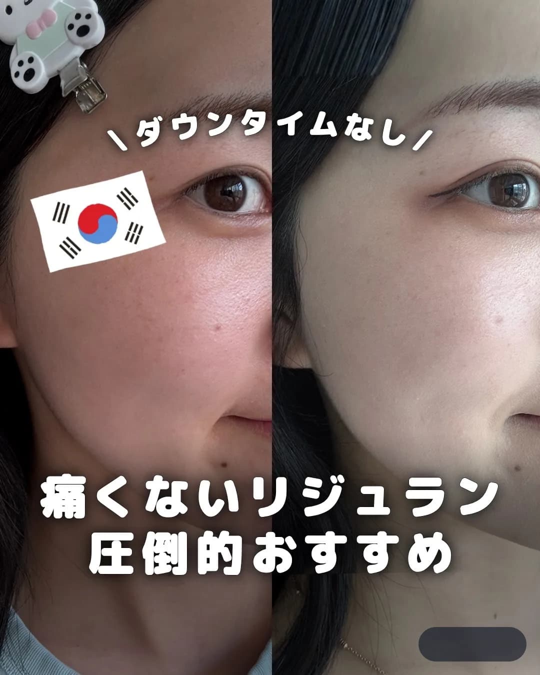 .
{ 痛くないリジュラン 圧倒的おすすめ }
今回行ってきたのは、
現地韓国人にも人気の
「テ
